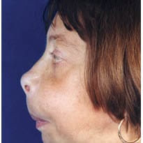 Photograph of the patient showing bulging of malar bones and widening of nares Q320