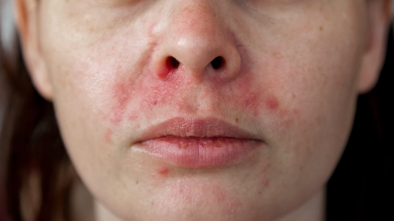 Atopic Dermatitis 1296x728 slide1 1