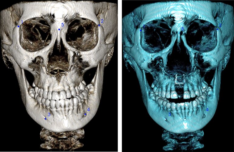 mse actually corrected asymmetry in this case which is very weird and different than the usual.jpg