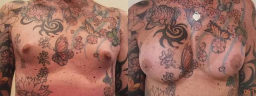 Male breast implants before after 1a