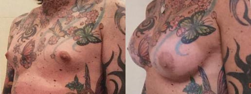 Male breast implants before after 1b