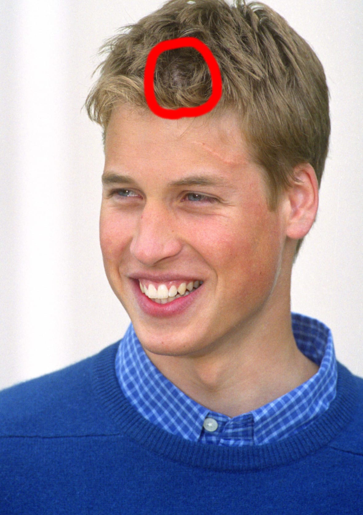 Prince william scar