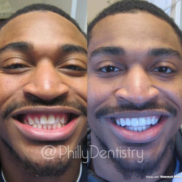 Jaelen Strong Veneers 600x600