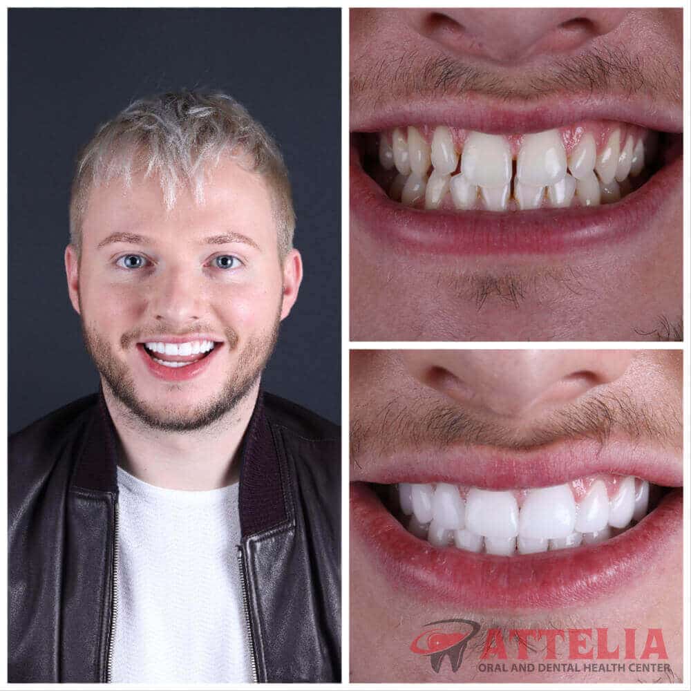 Smile makeover turkey 