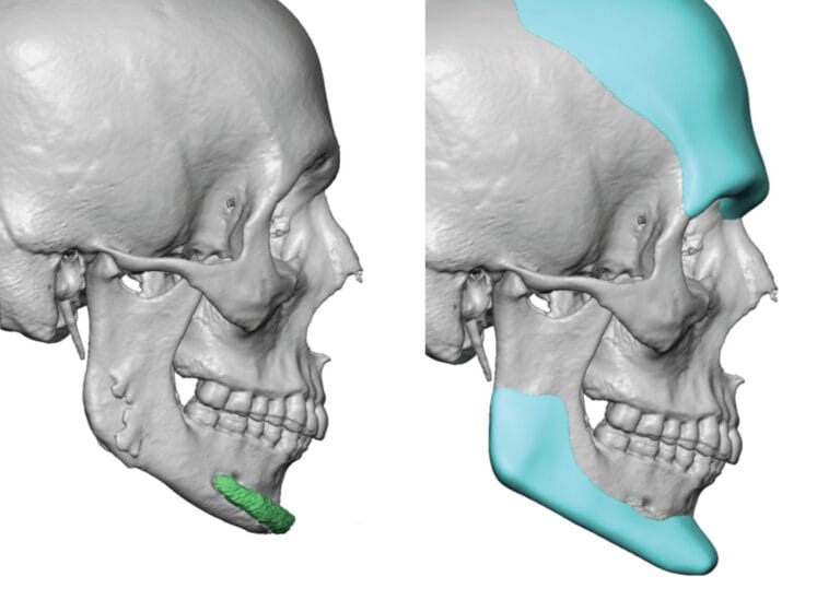 Male Custom Forehead Brow Bone and Jawline Implantys designs side view Dr Barry Eppley Indiana