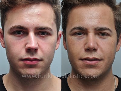 CV 1 Frontal Rhinoplasty ba 5mo