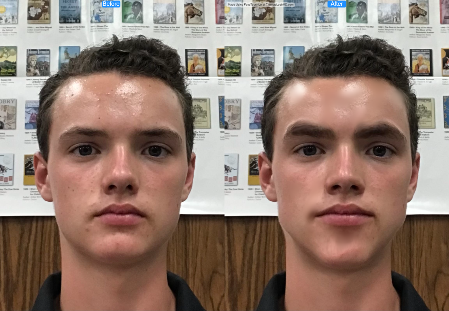 Teenmax before after