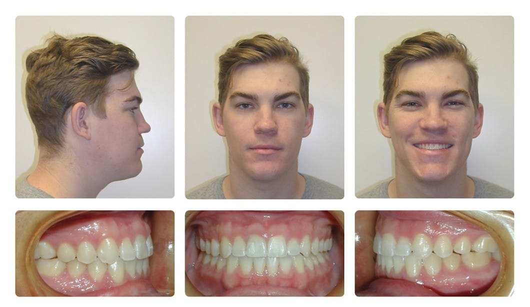 Patient 14 after