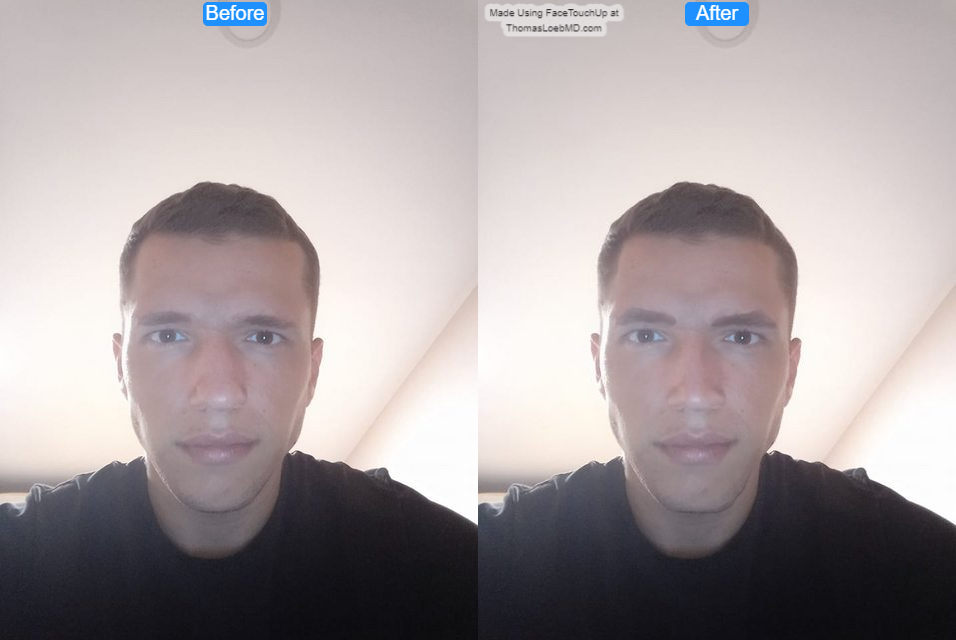 Gad before after