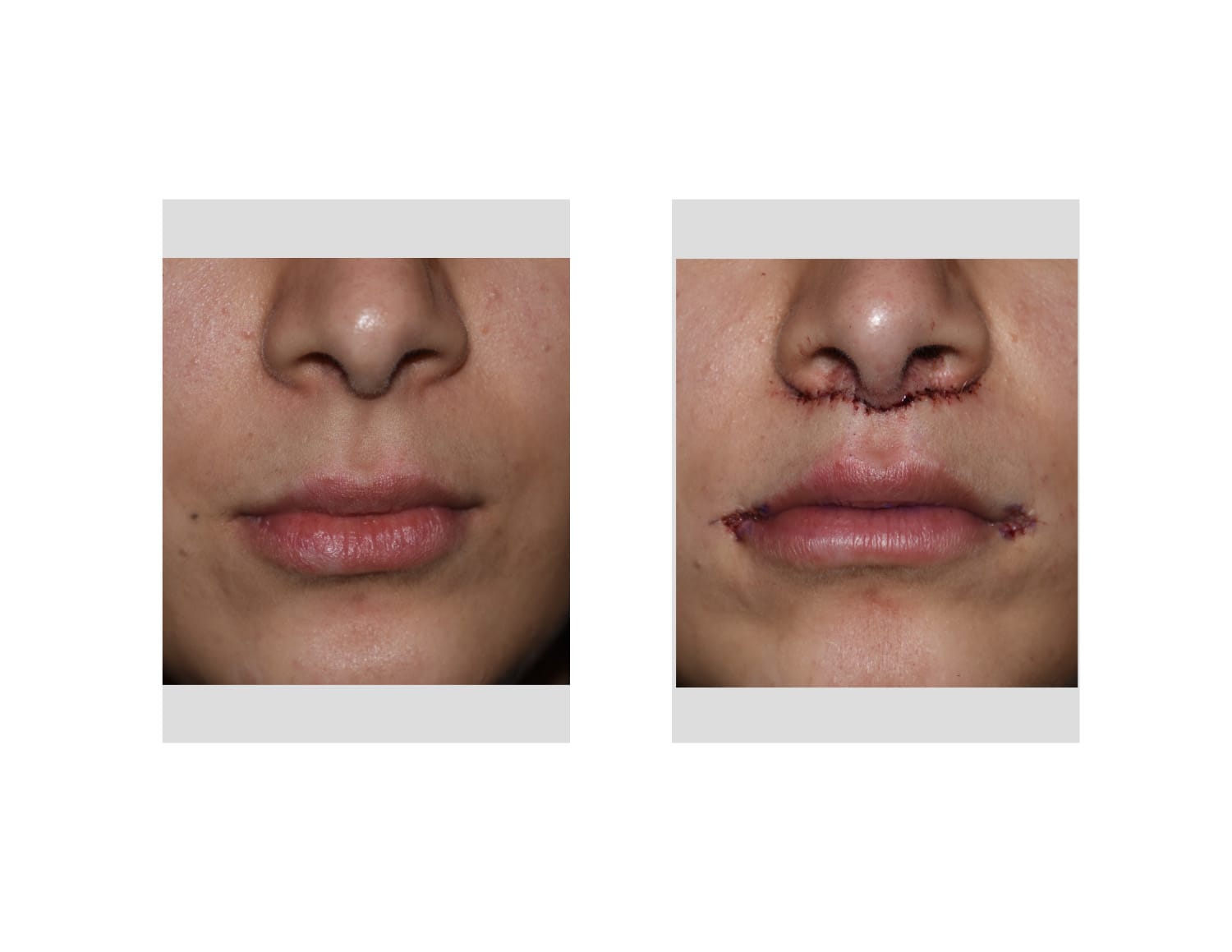 Subnasal Lip Lift and Mouth Widening Procedure immediate result front view Dr Barry Eppley Ind