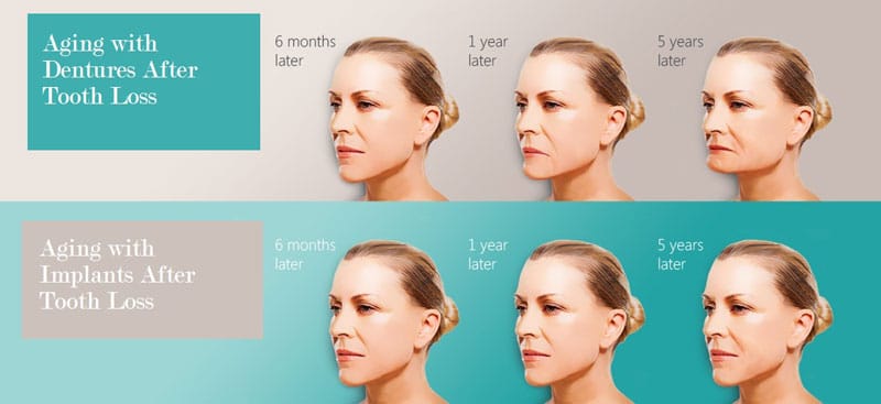 Aging with Dentures versus Implants