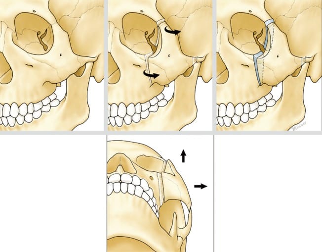 Tripod osteotomy Schema of orbital expansion by tripod osteotomy