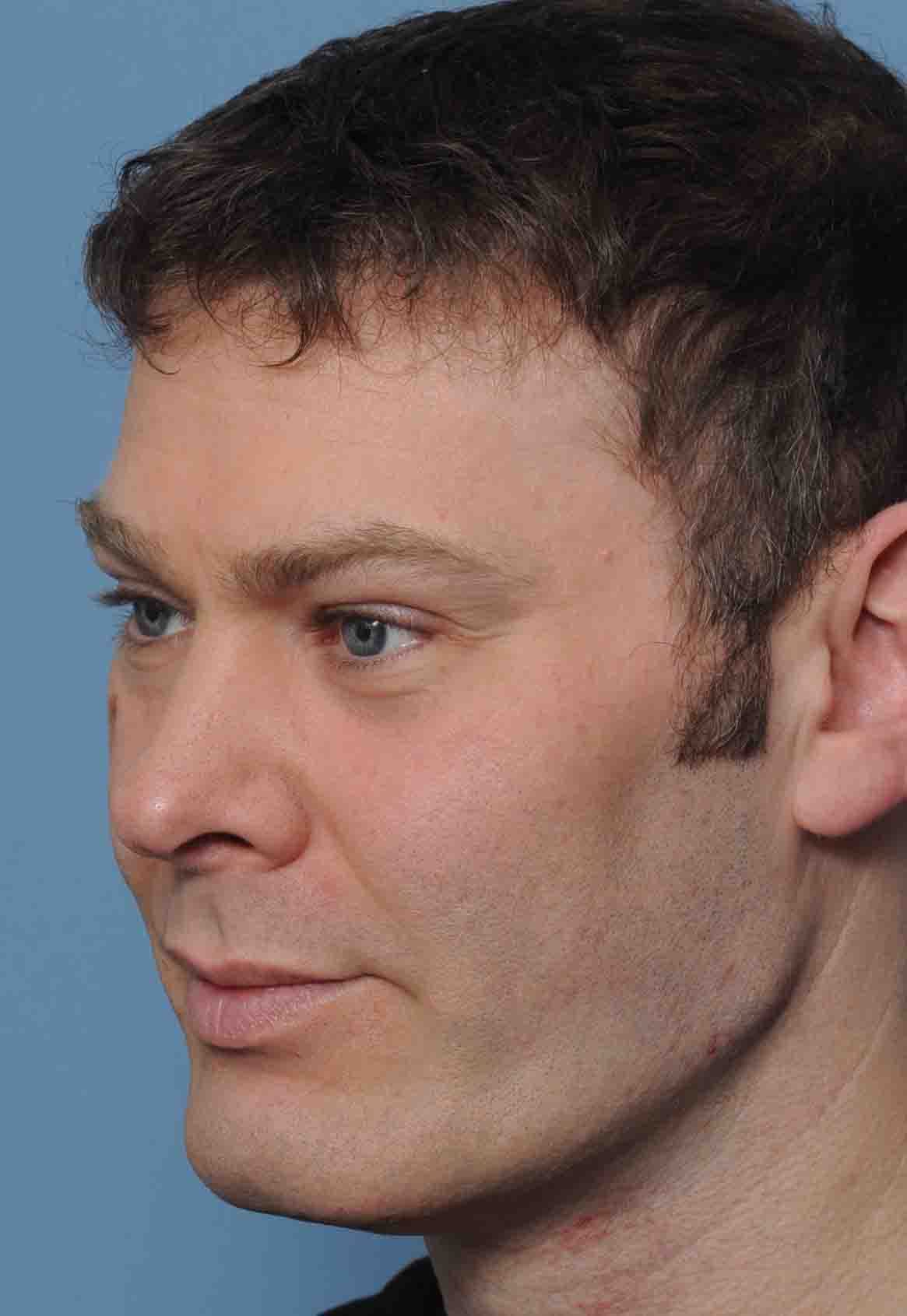 Custom Facial Implants 1b custom jawline and infraornital malar implants oblique after Dr Barr