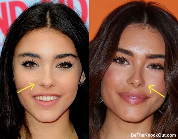 Madison beer nose job