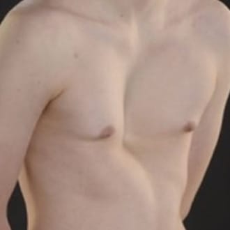 Pectus excavatum
