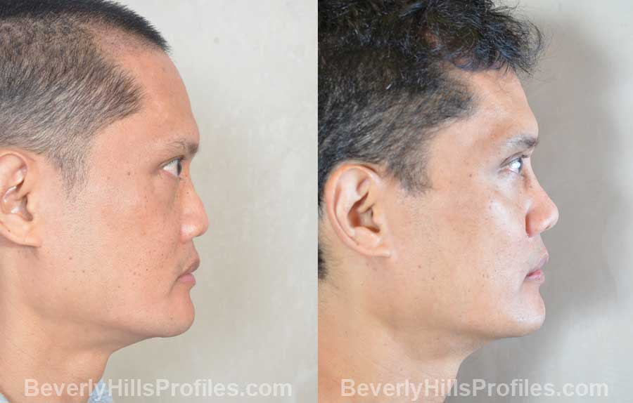 Ethnic Rhinoplasty Set 9 3