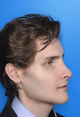 Aesthetische Chirurgie Kieferwinkel nacher 5 A