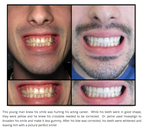 Smile Makeover Before and After Photos 570x519