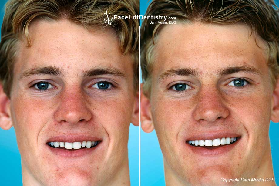 Porcelain veneers for small teeth