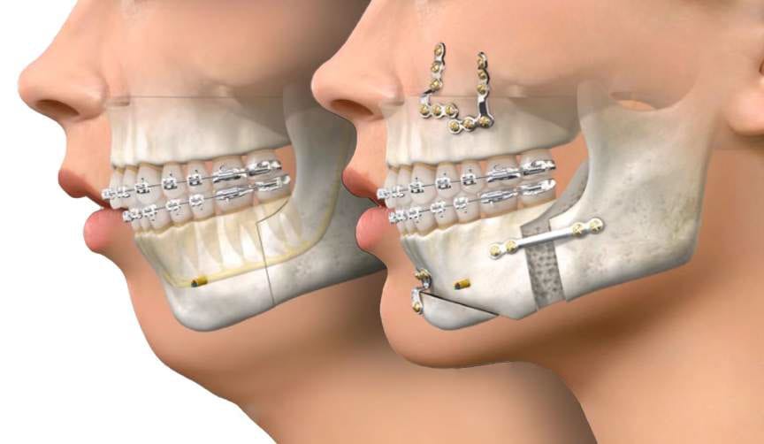 Img jaw surgery 20