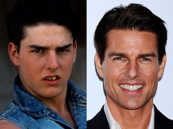 Ces stars qui ont refais leur dent 49