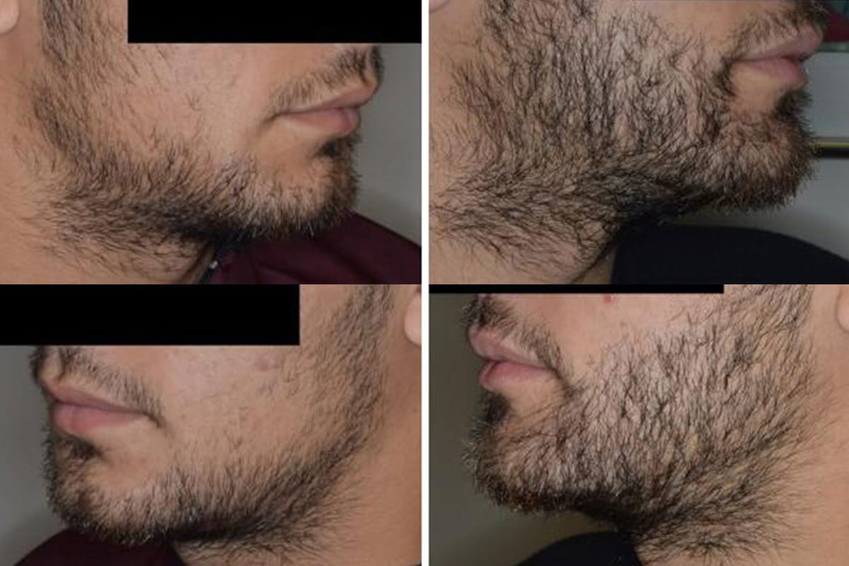 Beard transplant dr anthony bared miami fl 1