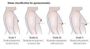 Gyno