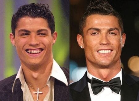 Before after ronaldo