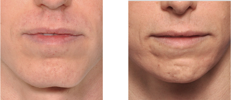 Chin Narrowing result front view Dr Barry Eppley Indianapolis