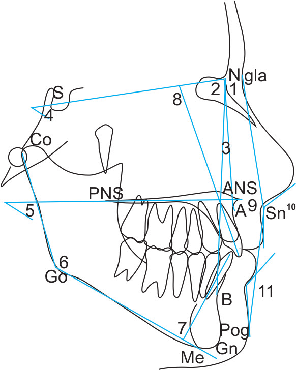 Angular measurements 1 SNA 2 SNB 3 ANB 4 SNGoMe 5 MM 6 CoGoMe 7 LIGoMe