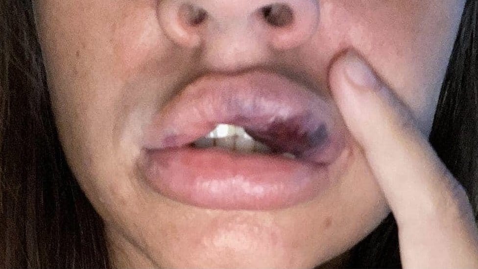  116580180 swollen