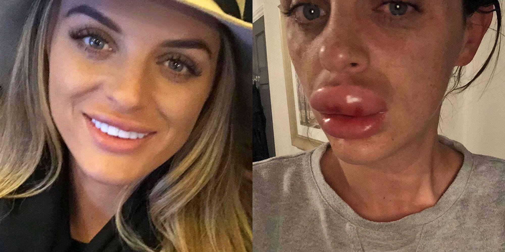 Lip filler 1544135422