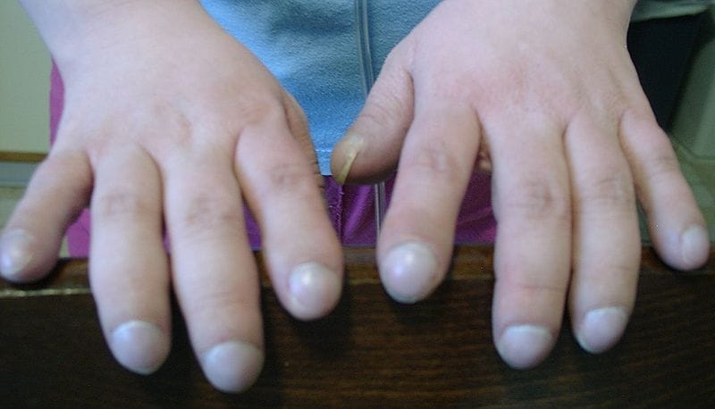 Fat fingers