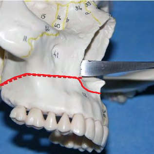 Osteot