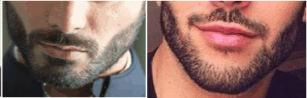 Stubble