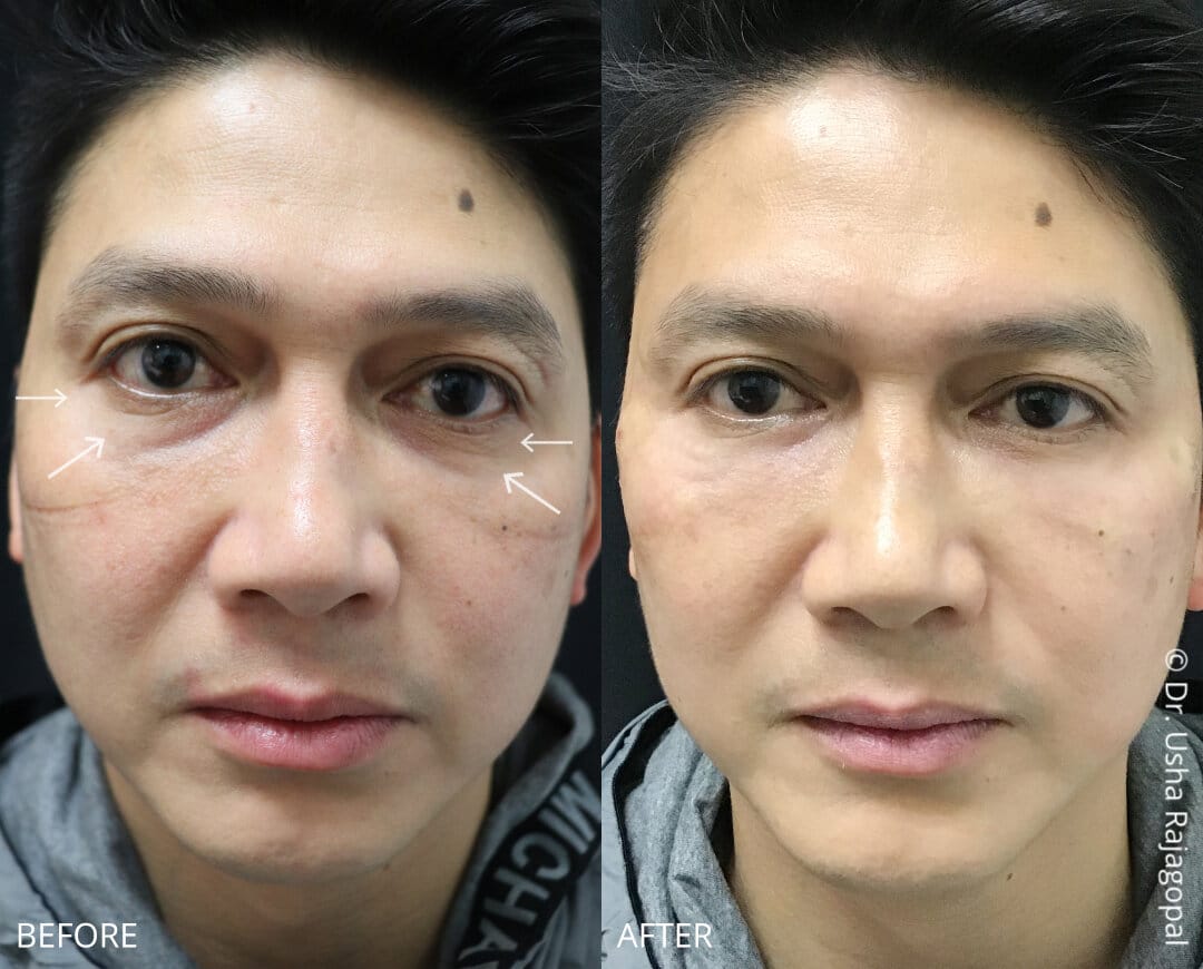 Voluma under eye ba 9