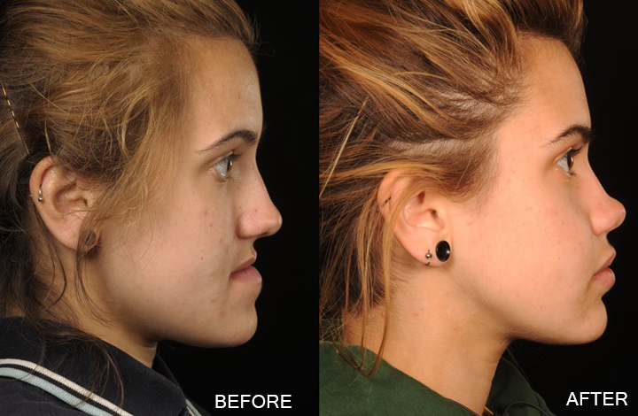 BEFORE AFTER LAUREN N02