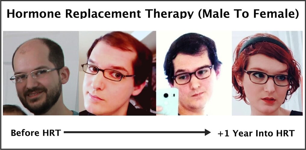 Hormone replacement therapy transgender hair regrowth
