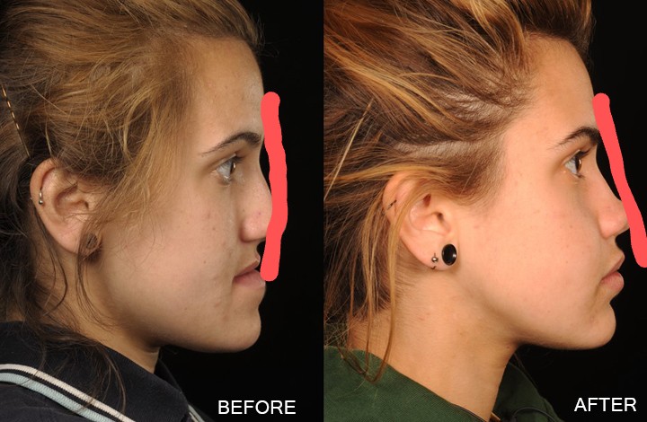 2617846 BEFORE AFTER LAUREN N022