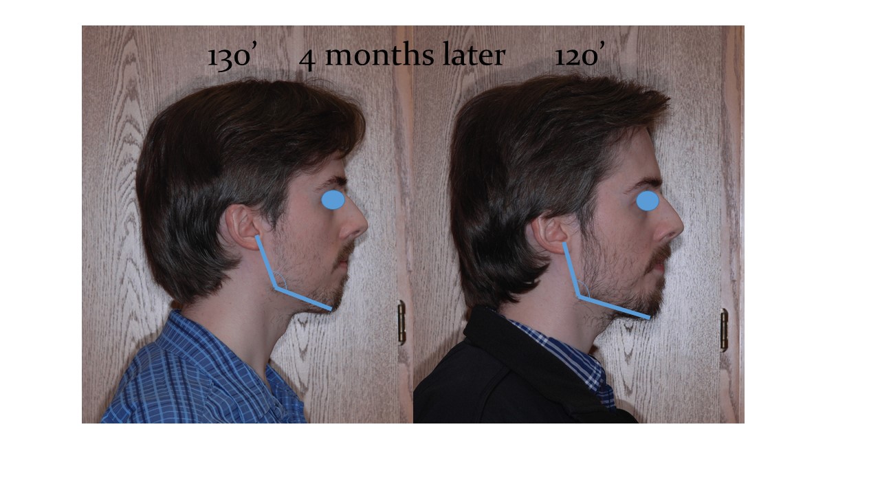 Jaw remodeling Jaw remodeling