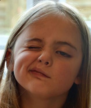 Bells palsy treatment 500x500