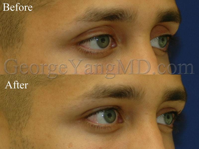 Upper eyelid filler BA 002WM copy