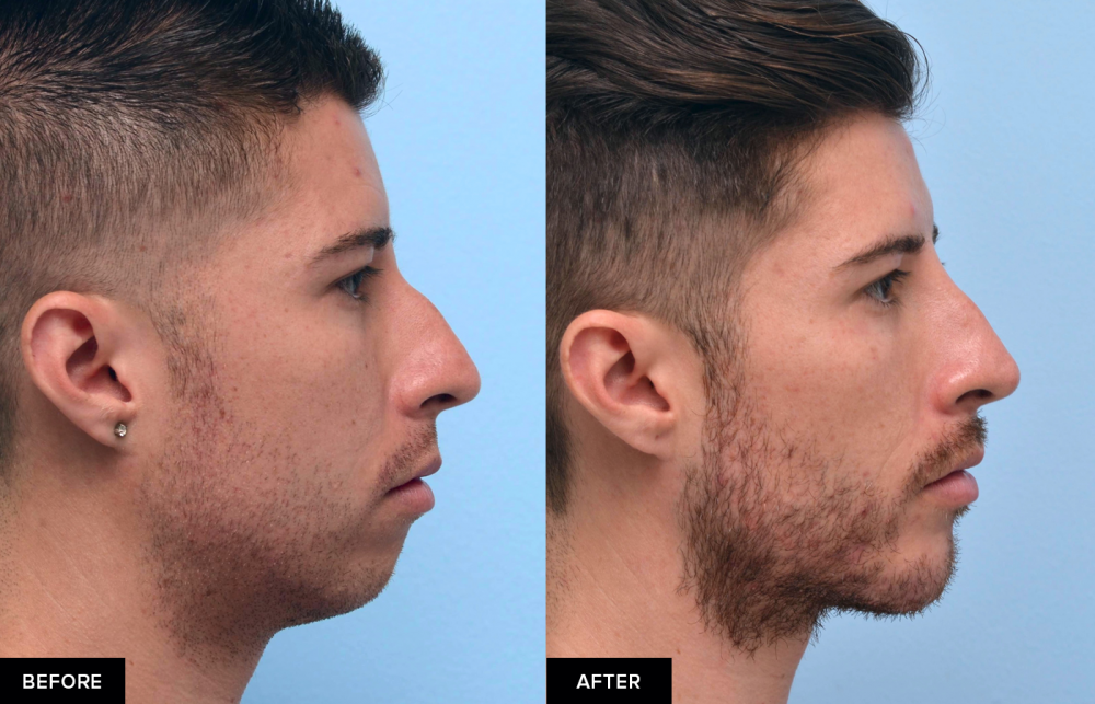 Filler chin
