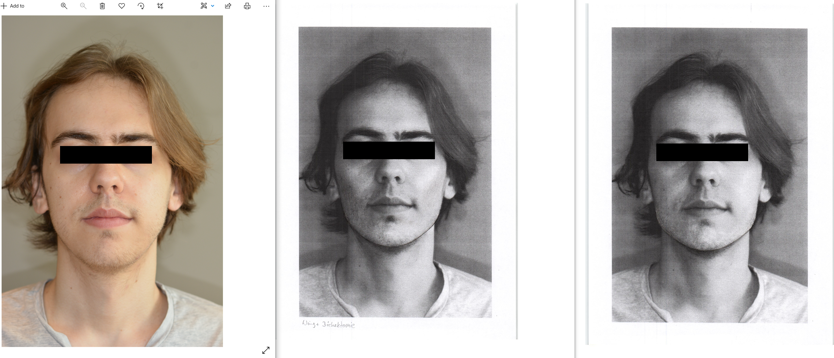 Frontal comparison anon   Copy
