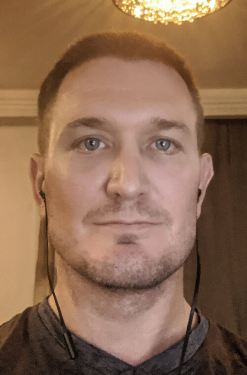 Zil jawsurgery Eppley jawcheekimplants uSearchForSymmetry 02 2xik0hh