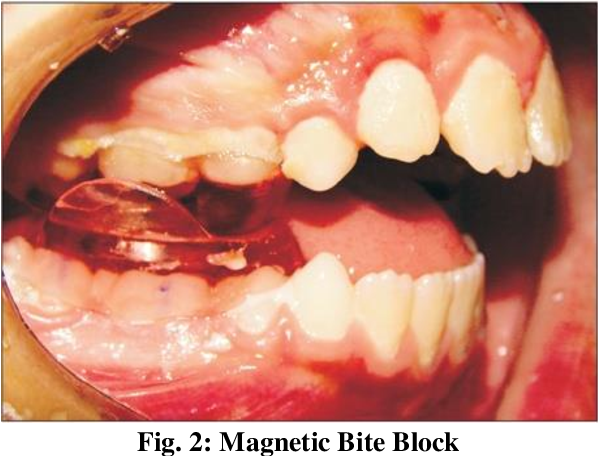 magnetic bite block.png