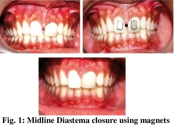 diastema.png