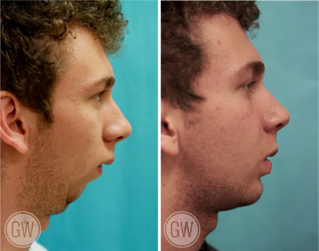 JawSurgery6 1024x807