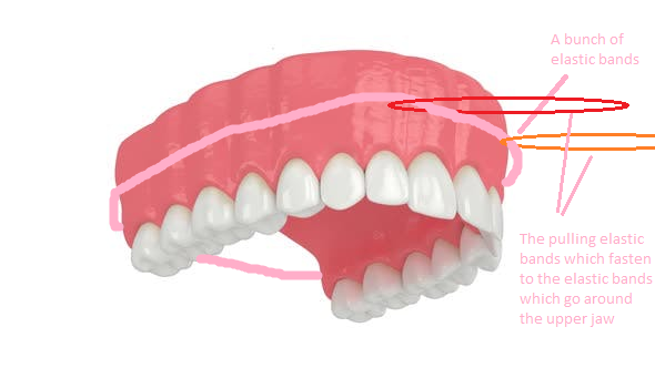 Bow upper jaw attachment