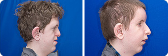 Apertboy side beforeafter
